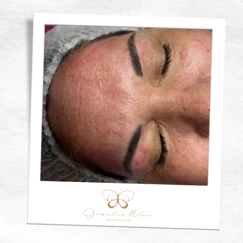 Estética facial em Araçariguama na Clínica Jacqueline Milani Espaço Estético, com protocolos personalizados para rejuvenescimento.